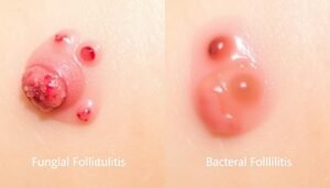 fungal folliculitis vs bacterial folliculitis